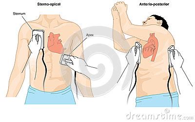 Defibrillation is a procedure used to treat life threatening conditions that affect the rhythm of the heart such as cardiac arrhythmia, ventricular fibrillation and pulseless ventricular tachycardia. Defibrillator Cardioversion Stock Vector - Image: 59137377