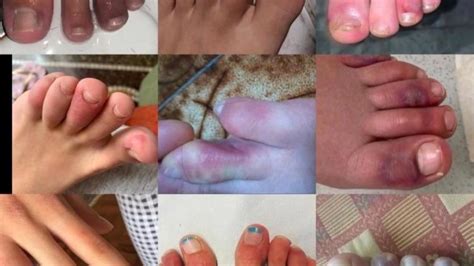 Dermatologists Link Swollen Discolored Toes To Covid 19 Exposure Wztv