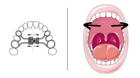 Palate Expander Can Change Your Face Heres How