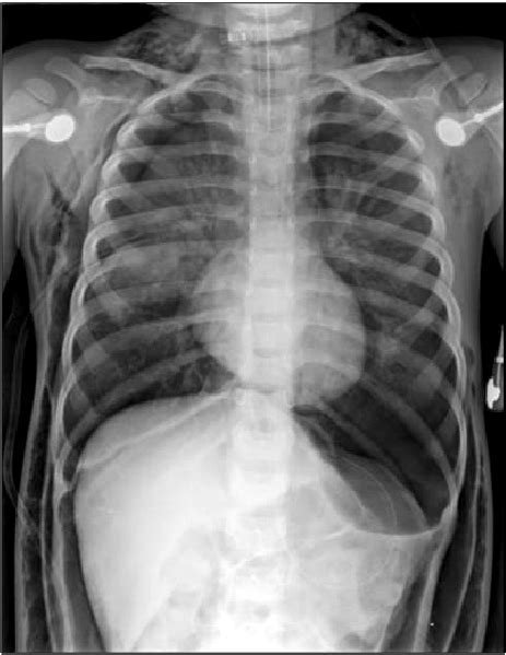 A Chest X Ray Showing Bilateral Pneumothorax Aggravated Download