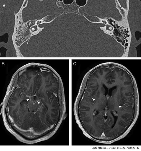 Indications And Radiological Findings Of Acute Otitis Media And Its