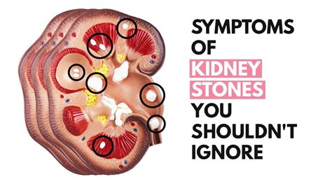 6 Symptoms Of Kidney Stones That You Might Not Be Paying Heed To