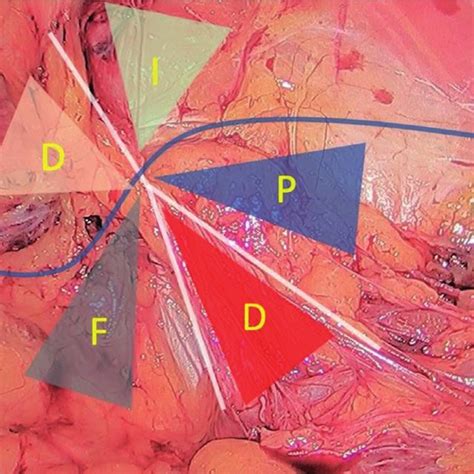 Inverted Y And Five Triangles Of The Inguinal Region Femoral Hernia