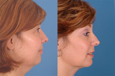 Neck Liposuction Before And After Photos Dr Bassichis