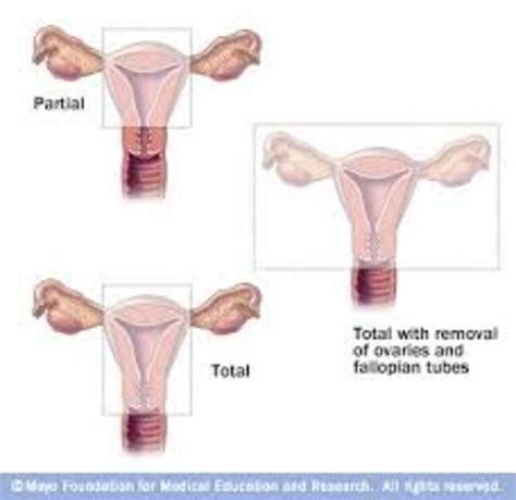 Total Hysterectomy At 25 The Consequences And Benefits To The Surgery On A Young Woman Hubpages