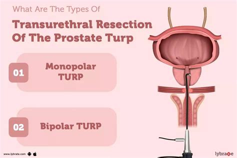 Transurethral Resection Of The Prostate Turp Purpose Procedure Benefits And Side Effects