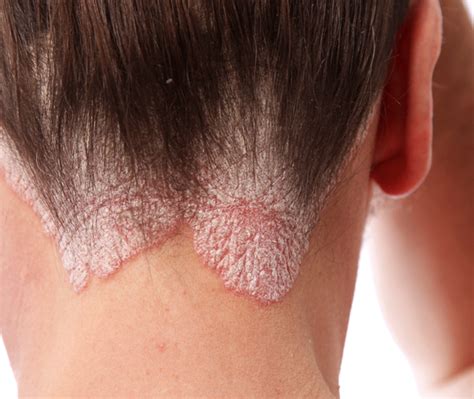 psoriasis 101 what you need to know about this common skin condition — health insight