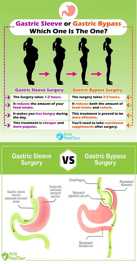 Gastric Bypass Vs Gastric Sleeve How Are They Different In