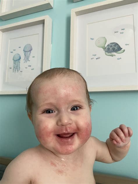 9 Ways To Alleviate Your Babys Eczema Symptoms Beans And Bravery