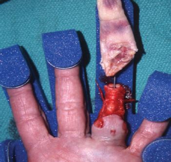 Microvascular Surgery | Daniel Calva-Cerqueira