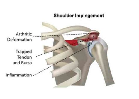 Diagram Of Shoulder Impingement Nyc Shoulder Impingement Treatment My