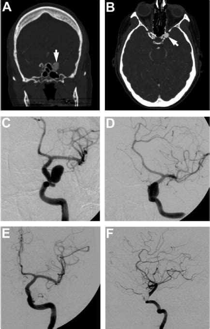 Cavernous Carotid Aneurysms To Treat Or Not To Treat In