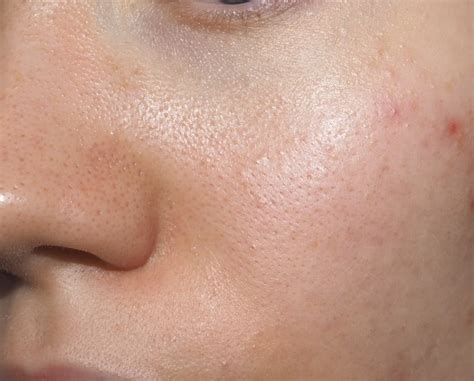 The One Part Of Your Face You Should Never Pop A Spot C45
