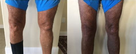Before And After 4 Months After Total Knee Replacement Surgery Total