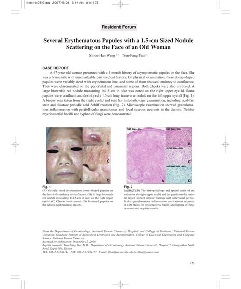 Pdf Several Erythematous Papules With A 15 Cm Sized Nodule