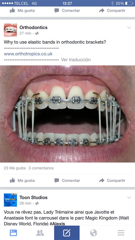 Elasticos Brackets Salud Dental Dental