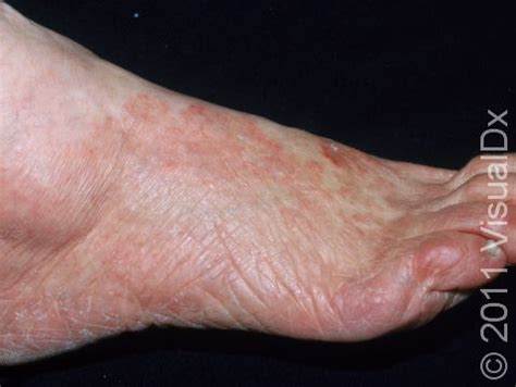 Athletes Foot Tinea Pedis Condition Treatments And Pictures For