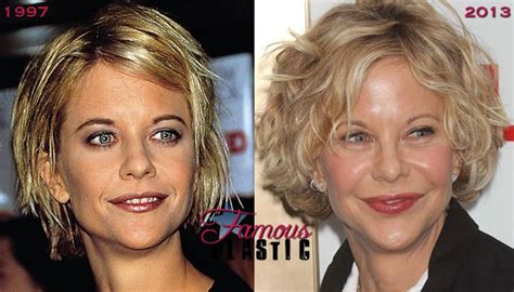 Meg Ryans Before And After Plastic Surgery Photos Should Warn People