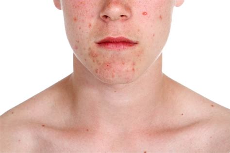 Acne Treatment Understand Your Patients Options