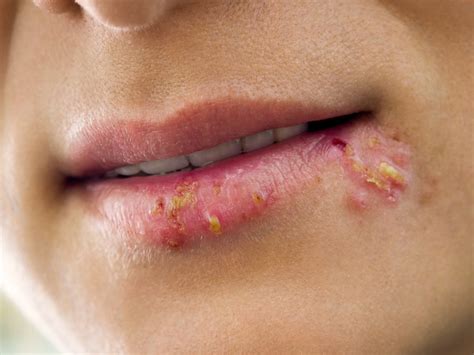 22 Home Remedies For Cold Sores And How To Use Them Naturally Daily