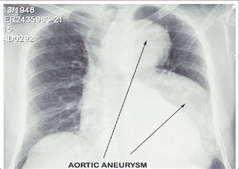 Routine Chest X Ray That Revealed A Dilatation Of The Arch And