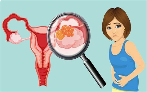 Síntomas Del Cáncer De Ovario Que Tienes Que Saber Salud Chicas