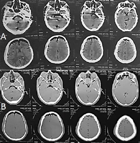 Ct Scan Of The Brain A Soft Tissue Axial Cuts And B Bone Window