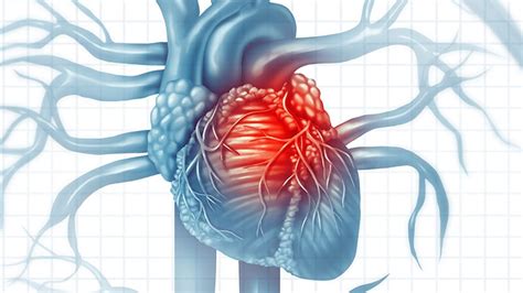 New Esc Guidelines On Adult Congenital Heart Disease Medscape