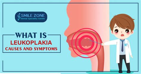 Leukoplakia Causes And Symptoms