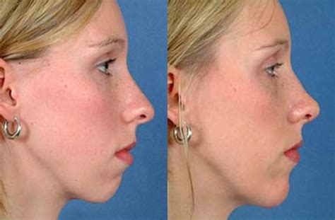 Nose Reshaping Before And After Photo Gallery Louisville And Lexington