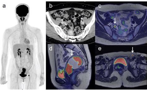 A 53 Year Old Woman With Ivb Cervical Cancer And Pelvic Lymph Node