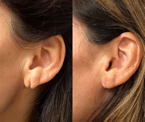 Earlobe Repair Before And After Photos Upper East Side New York Ny