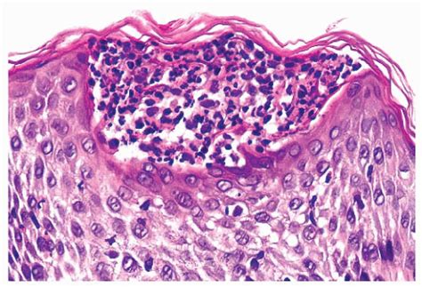 Nonneoplastic Diseases Of The Skin Basicmedical Key