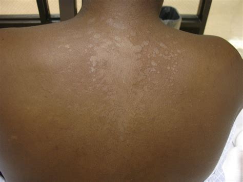 Fungus Tinea Versicolor Perri Dermatology