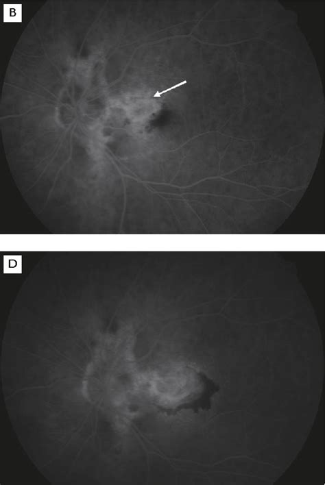 Figure 1 From Intravitreal Injection Of Bevacizumab For The Treatment