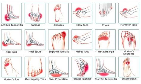 Foot Pain Introduction Causes And Treatment