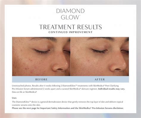 Diamond Glow Facial Treatment In Avon Ct Inner Glow Aestheticsmd