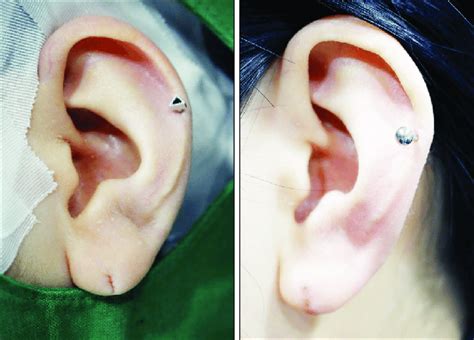 Results Two Weeks After Simple Correction Of Split Earlobe Download