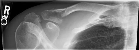 Distal Clavicle Fracture