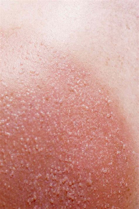 The Sun Poisoning Symptoms You Should Know—and How To Treat Them 1