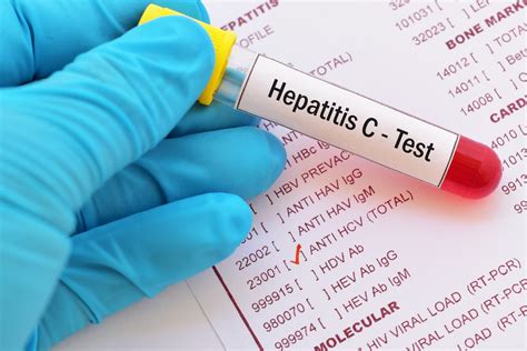Hepatitis C Gejala Cara Menangani Dan Pengobatan Honestdocs My XXX Hot Girl