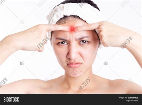 Large Acne Pimple Image And Photo Free Trial Bigstock