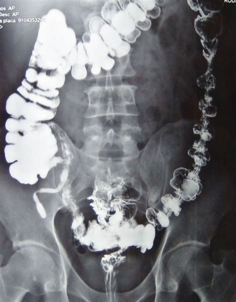A colon often precedes an explanation, a list, a quotation, or a block quotation. Endoscopia y Cirugía Digestiva: RADIOGRAFIA DE COLON POR ...