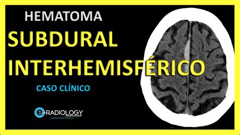 🧑🏻‍⚕️ Hematoma Subdural Agudo 🤕 Interhemisferico Caso Clinico
