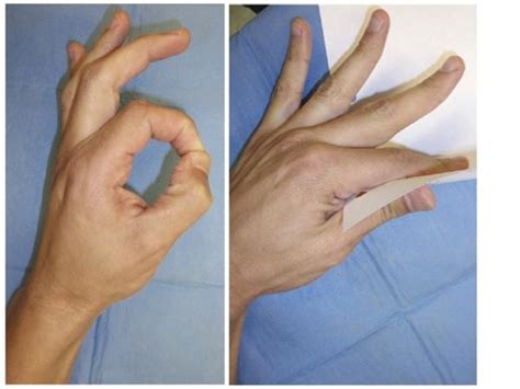 Ain Compressive Neuropathy Hand Medbullets Step 1