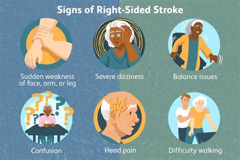 Right Sided Stroke Effects Treatment And Recovery