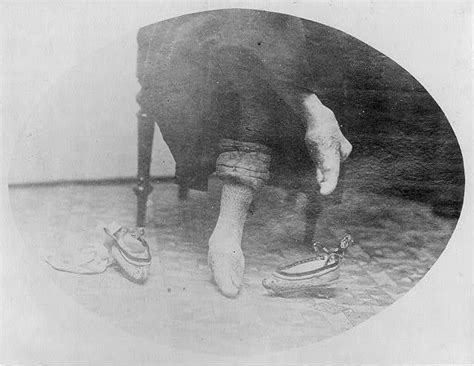 Photo Chinac1900bound Feetdeformed To Shape Of Small
