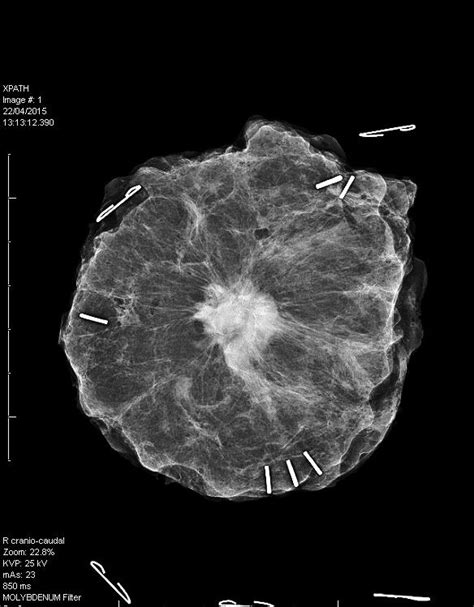 This Is What Breast Cancer Looks Like On An X Ray Rpics