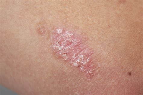 Overview Of Psoriasis And Treatment Options