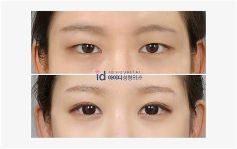 Id Hospital Korea Faq Eyelid Surgery Everything You Need To Know Beautiful Bright Eyes